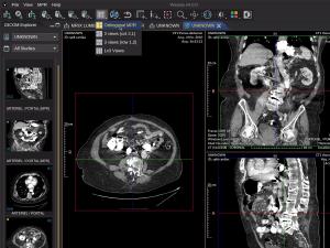 Orthogonal Multiplanar Reconstruction