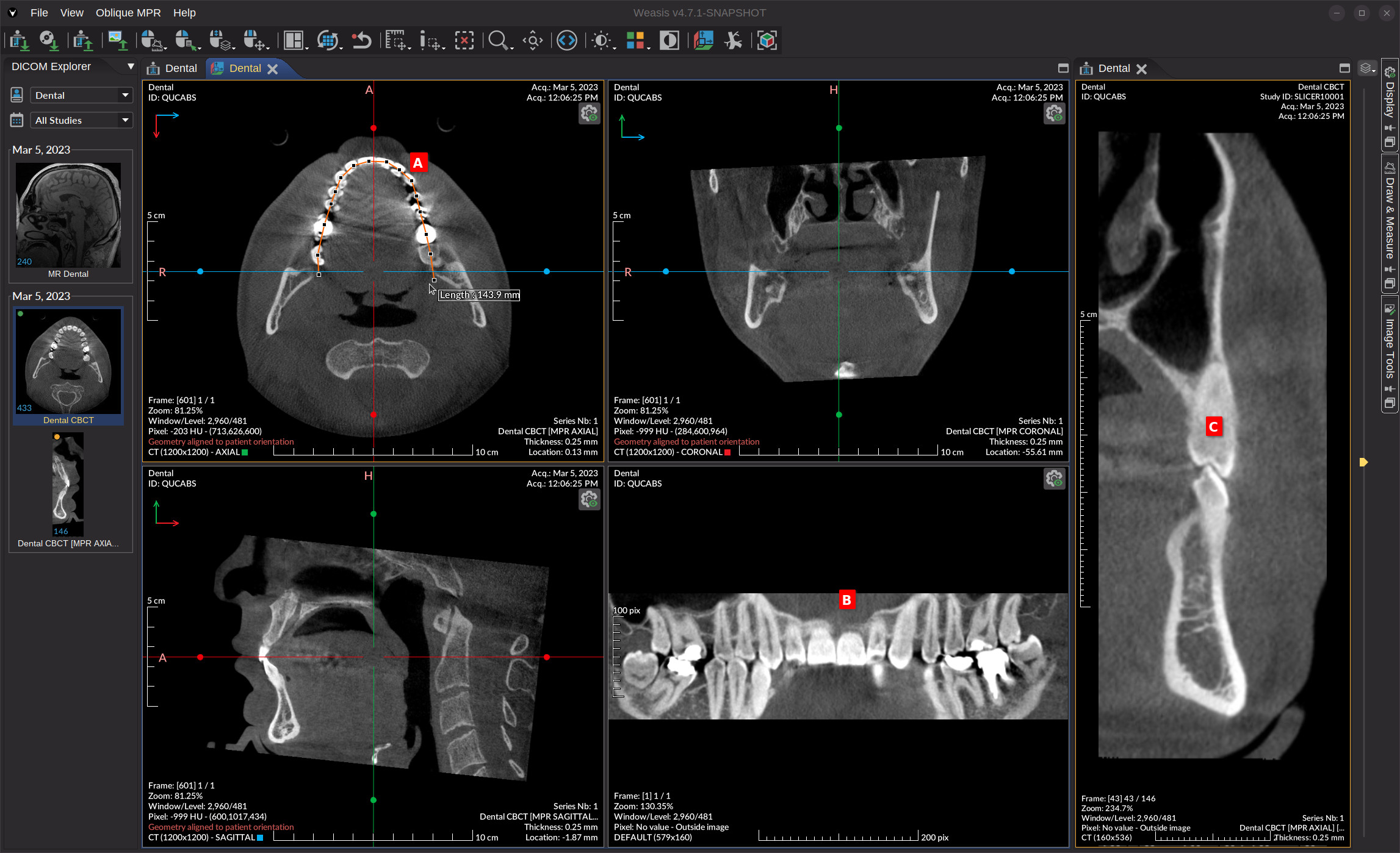 Curved MPR panoramic and cross-sectional series of a dental CBCT