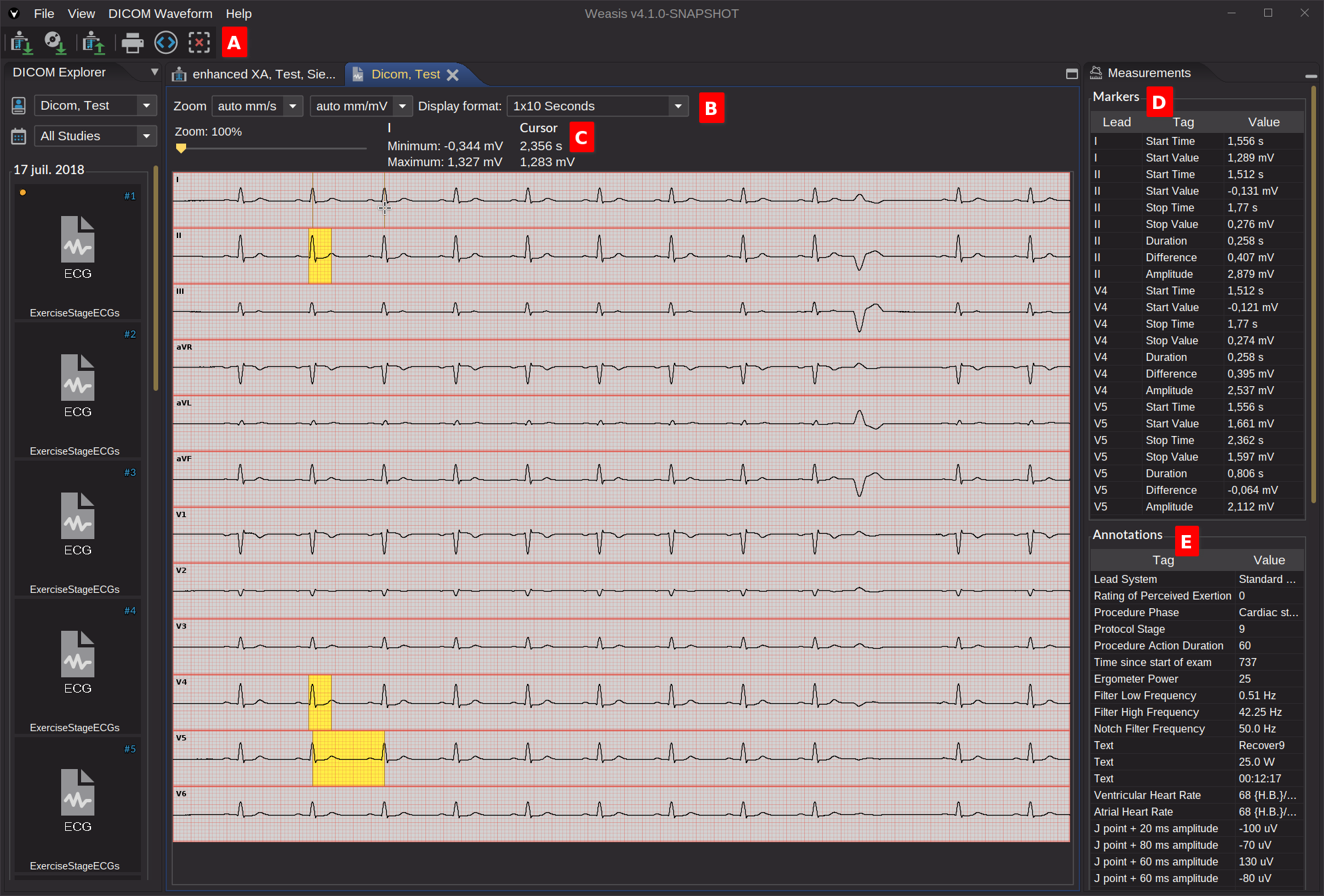 ECG Viewer