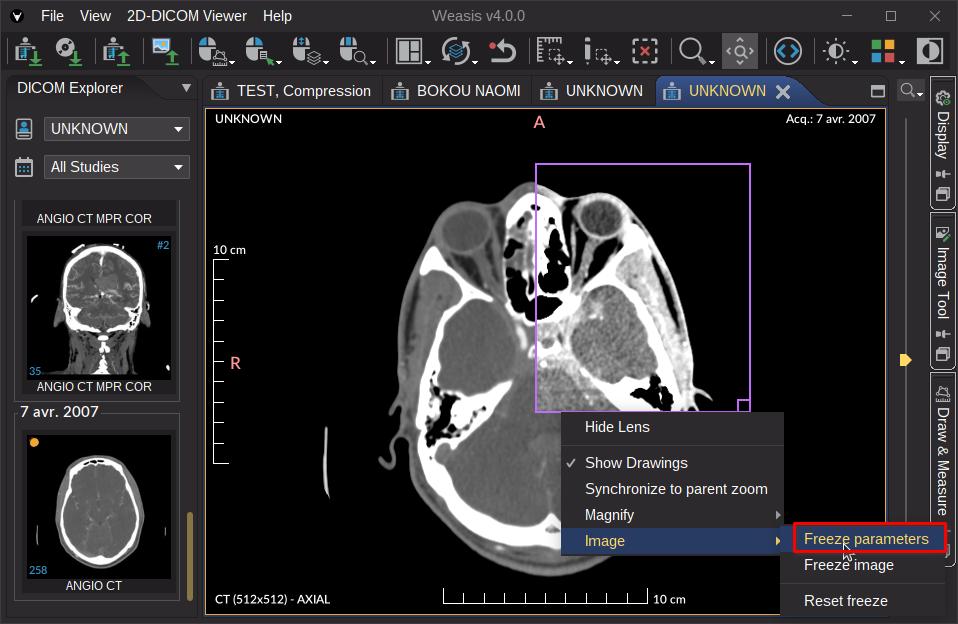 Lens with frozen parameters